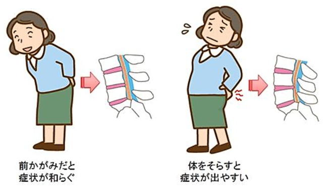 脊柱管狭窄症イメージ