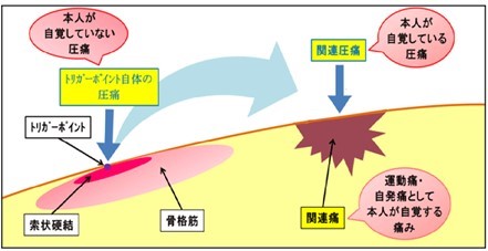 関連痛