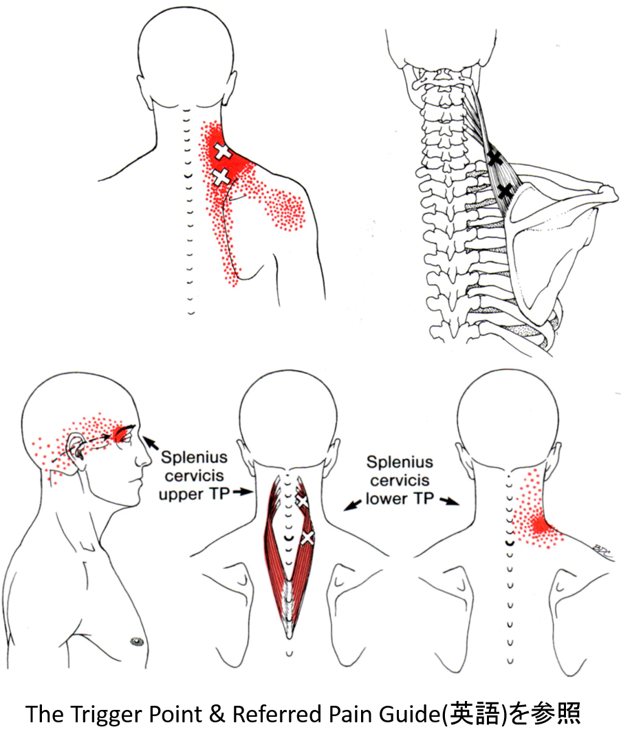 頸椎神経根症 トリガーポイント