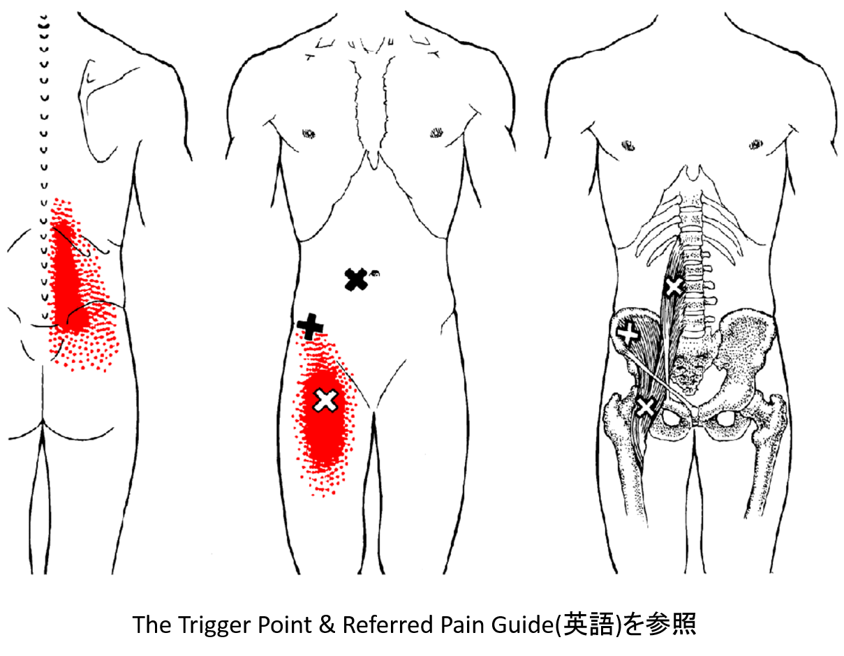 ぎっくり腰　トリガーポイント