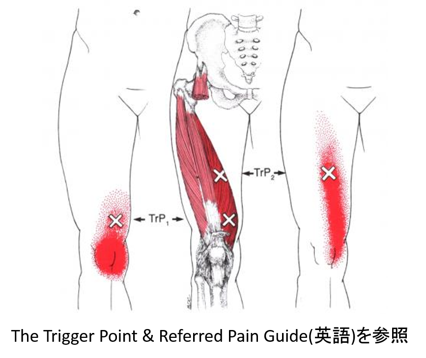 膝の痛み　トリガーポイント