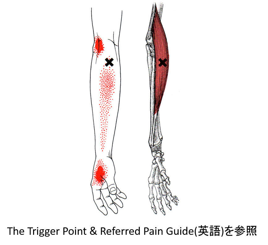 腱鞘炎　トリガーポイント