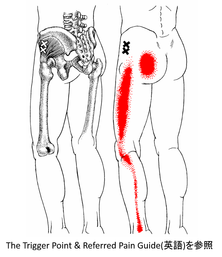 腰椎椎間板ヘルニア　トリガーポイント
