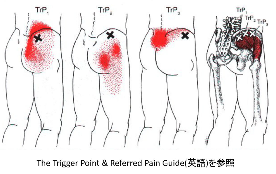 股関節の痛み　トリガーポイント