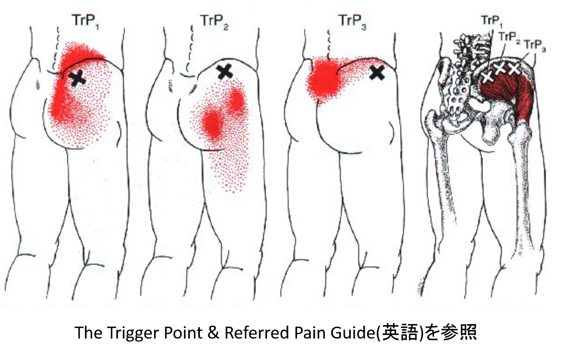 股関節の痛み トリガーポイント療法専門 もりかわ鍼灸治療院