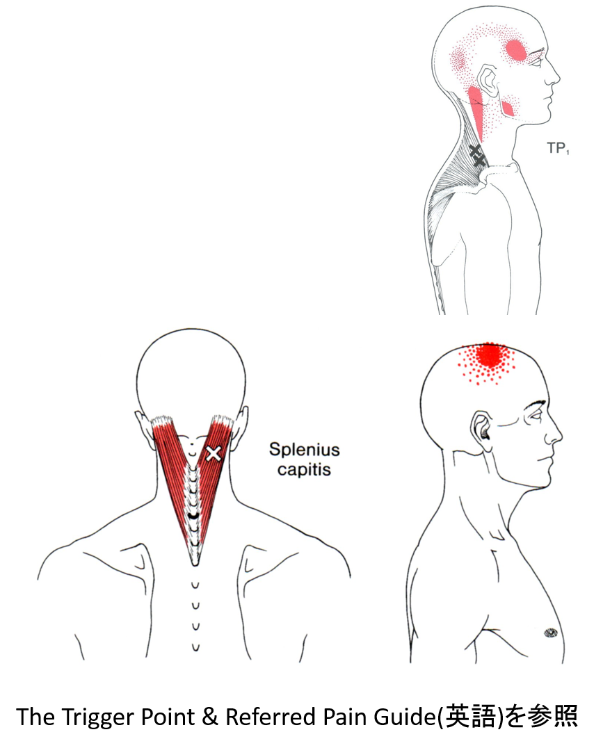 頭痛 トリガーポイント