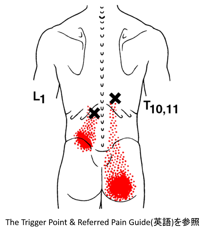 腰痛　トリガーポイント