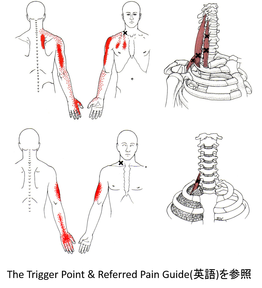頸椎ヘルニア トリガーポイント