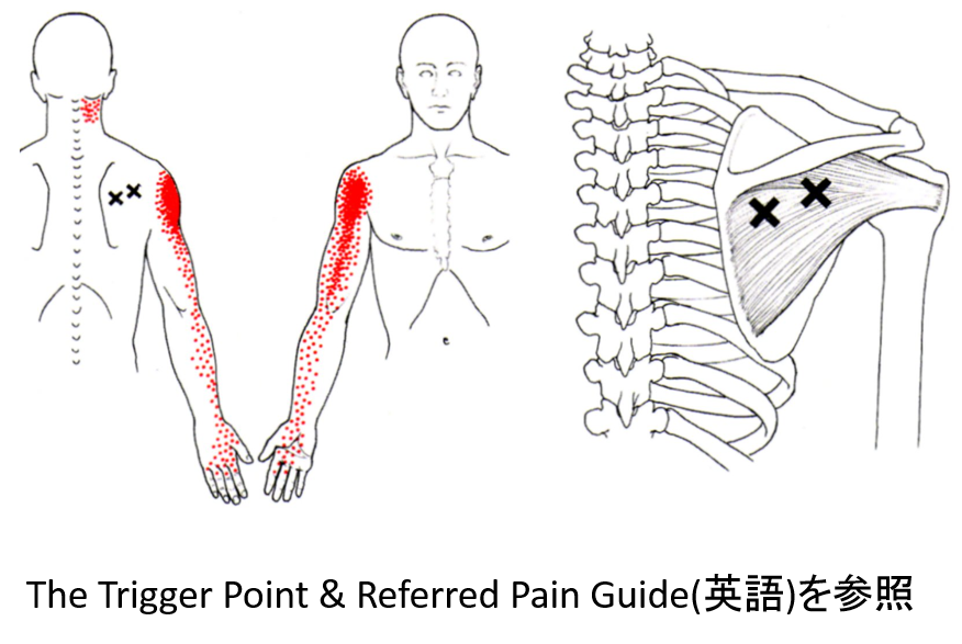 五十肩　トリガーポイント