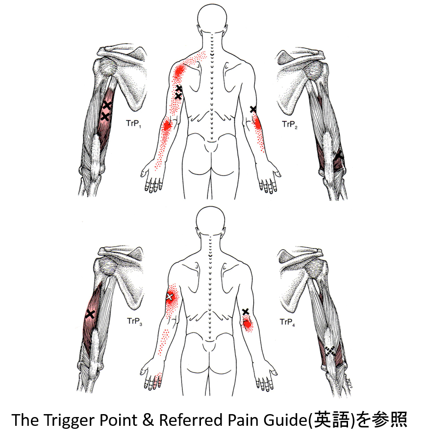 野球肘・ゴルフ肘・テニス肘　トリガーポイント