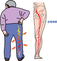 坐骨神経痛イメージ