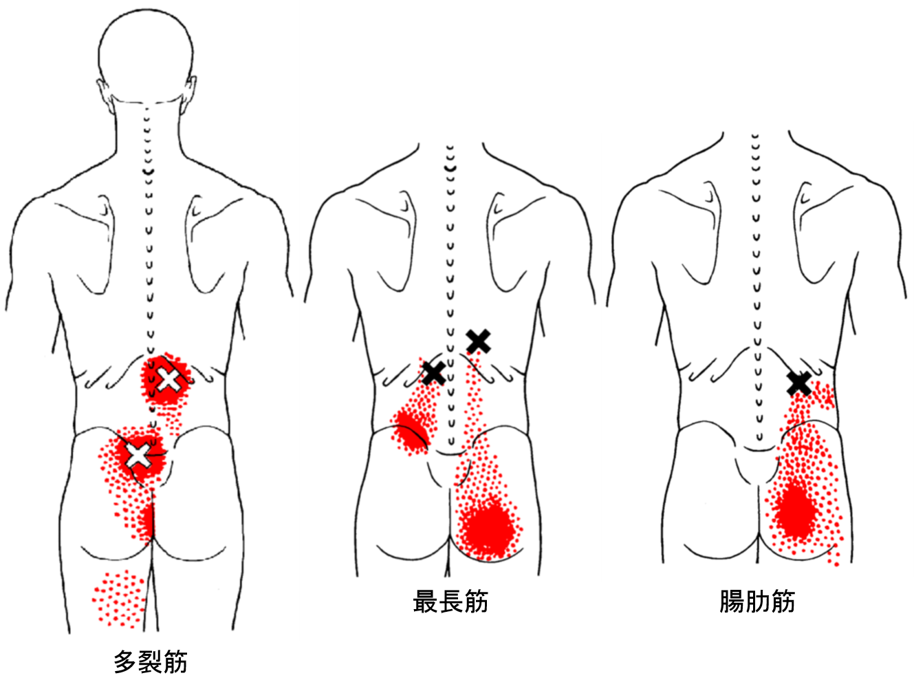 脊柱起立筋トリガーポイント