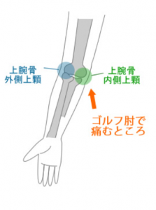 ゴルフ肘