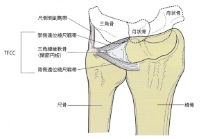 TFCC損傷図