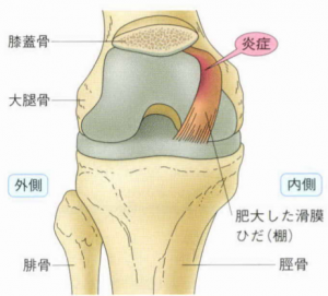 滑 膜 ひだ 障害