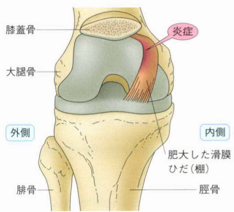 膝の痛み タナ障害 について はロックされています 膝の痛み タナ障害 について トリガーポイント療法専門 もりかわ鍼灸治療院 膝の痛み タナ障害 について はロックされています 膝の痛み タナ障害 について トリガーポイント療法専門 もりかわ鍼灸治療院